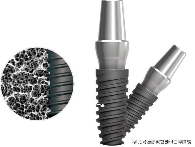 南京无痛全口种植牙医院：进口全烤瓷牙多少钱一颗